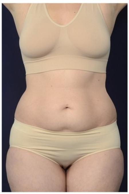 Before image 1 Case #87556 - Abdominoplasty