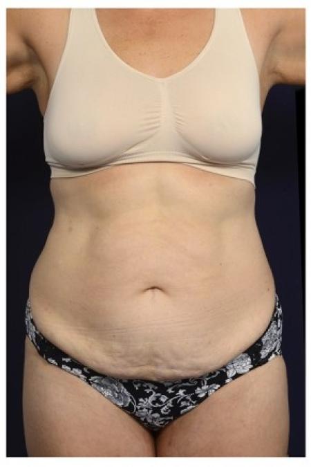 Before image 1 Case #84521 - Abdominoplasty