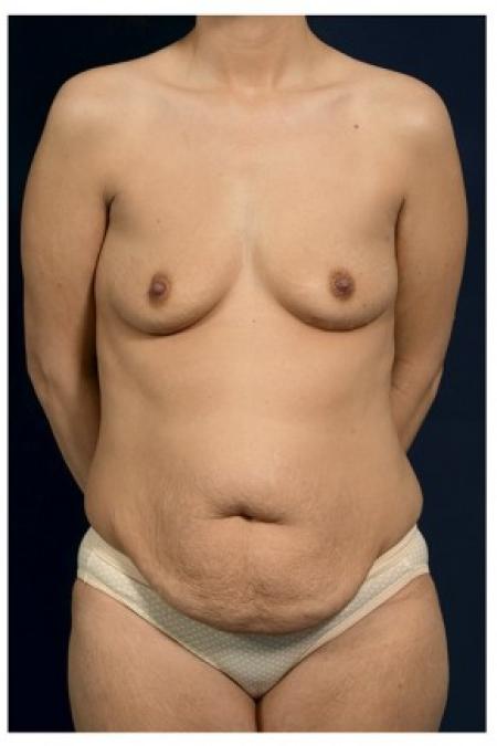 Before image 1 Case #84776 - Mommy Makeover