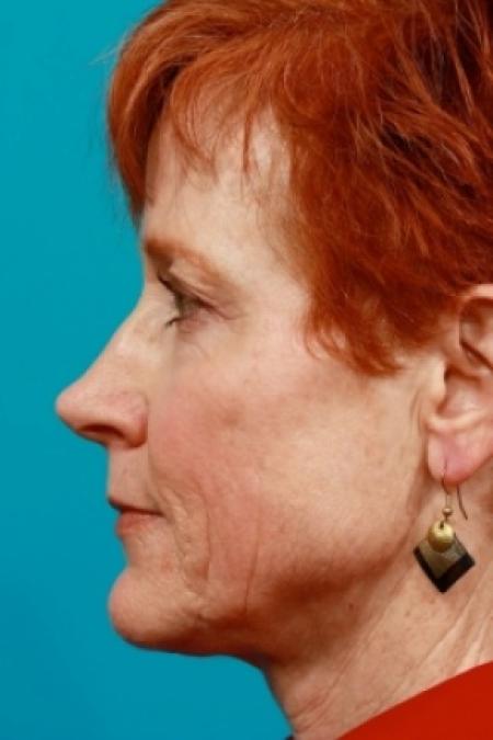 Before image 2 Case #78911 - Upper Blepharoplasty