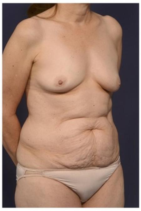 Before image 2 Case #84756 - Mommy Makeover