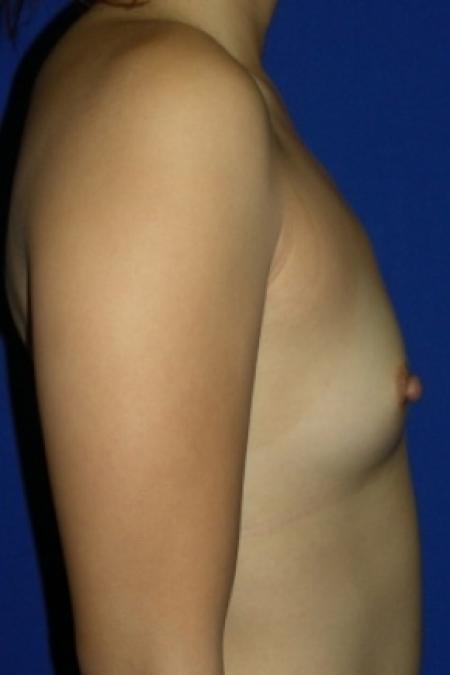 Before image 3 Case #79776 - Breast Enlargement with Silicone Implants
