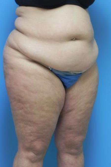 Before Case #80956 - Lower body lift and medial thigh lift
