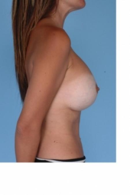 Before image 3 Case #80606 - Reaugmentation of the breast