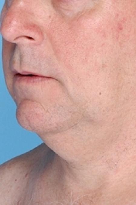 Before image 2 Case #79321 - Non-Surgical Focused Ultrasound