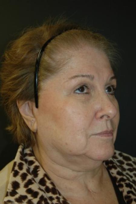 Before image 2 Case #81326 - Facelift, Lateral Browlift, Fat Transfer