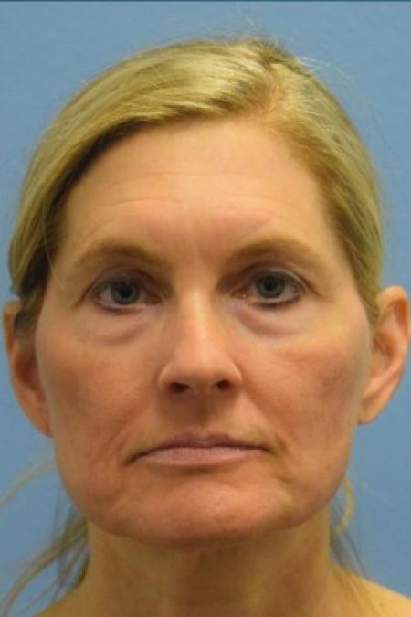 Before image 1 Case #86146 - Minimal Access Cranial Suspension (MACS) Lift