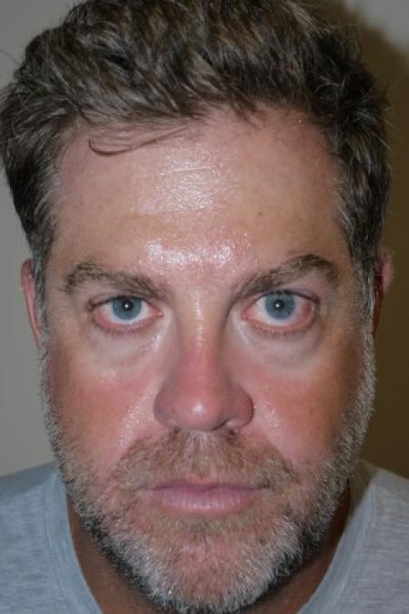 Before image 1 Case #82311 - 43 year old after 3 syringes of Juvederm Voluma for cheeks
