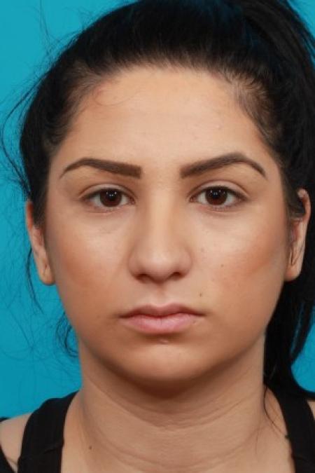 Before image 1 Case #83921 - Rhinoplasty with Chin Augmentation