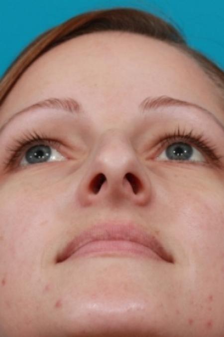 Before image 4 Case #78781 - Rhinoplasty (Nose Reshaping)