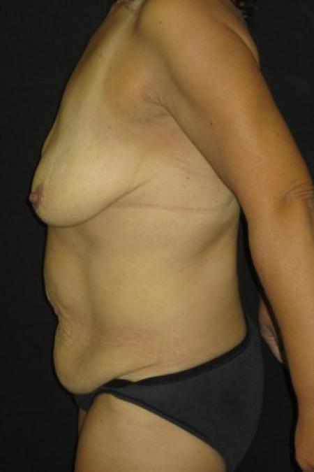 Before image 2 Case #82766 - Abdominoplasty and Full Mastopexy
