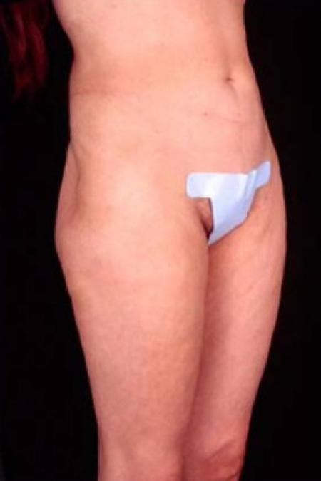 Before image 1 Case #81666 - Liposuction