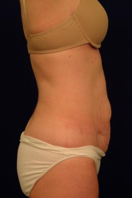 Before image 3 Case #87681 - Abdominoplasty