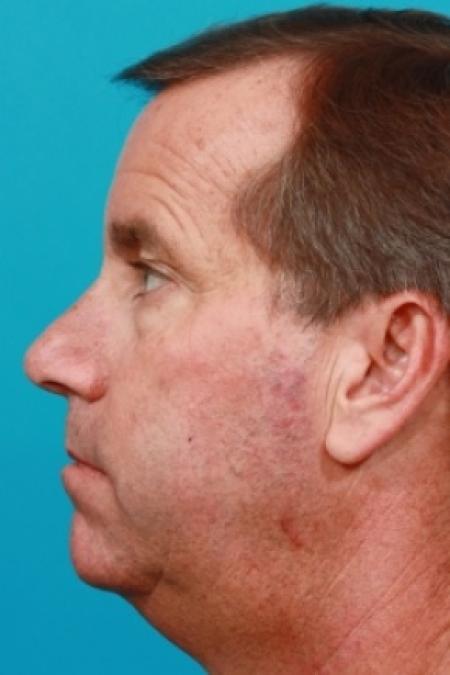 Before image 2 Case #78876 - Lower Blepharoplasty