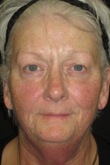 Before image 1 Case #82681 - 67 Year Old Woman's Facial Rejuvenation