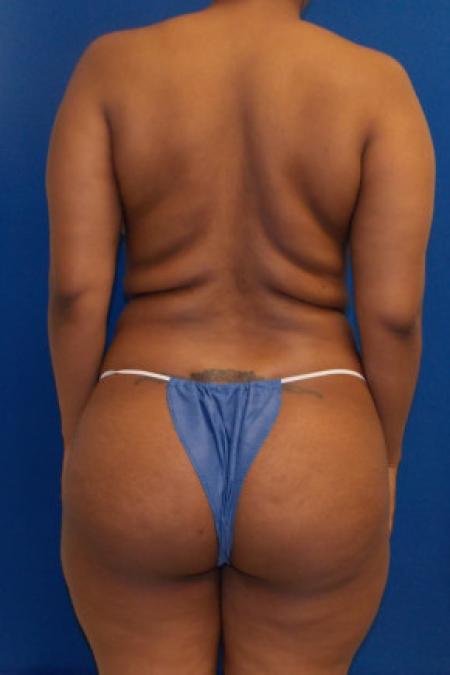 Before Case #88321 - Brazilian Buttock Lift 