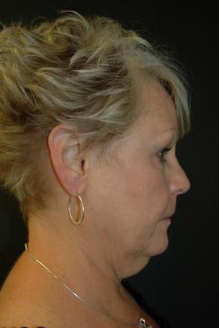 Before image 3 Case #80871 - Facelift, Fat Transfer, Lower Blepharoplasty
