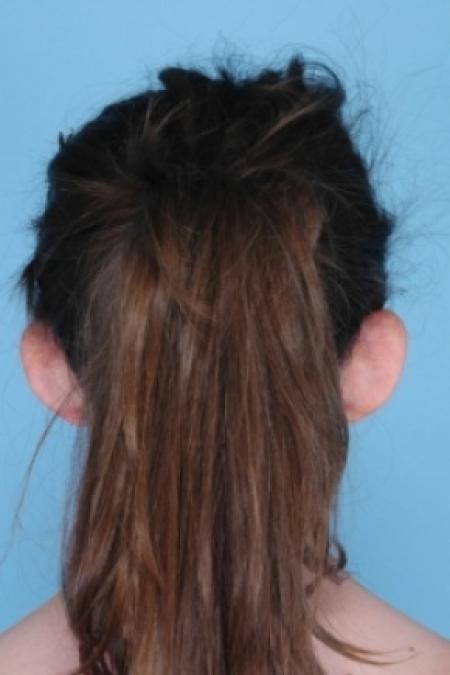 Before image 3 Case #79521 - Ear Surgery