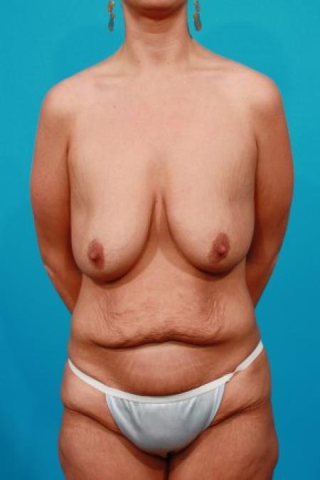 Before image 1 Case #83026 - Surgery after MWL
