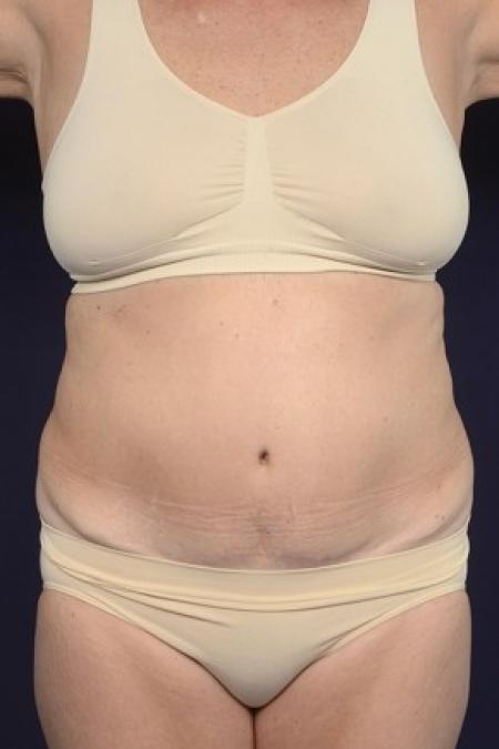 Before image 1 Case #87521 - Trunk Liposuction