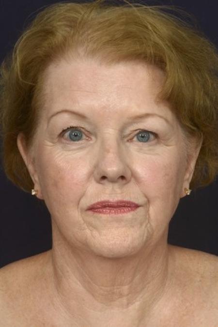Before image 1 Case #87141 - Full Facial Rejuvenation