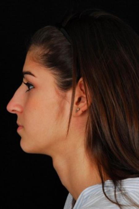 Before image 3 Case #81561 - Rhinoplasty