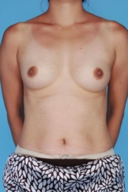 Before image 1 Case #80551 - Breast Augmentation