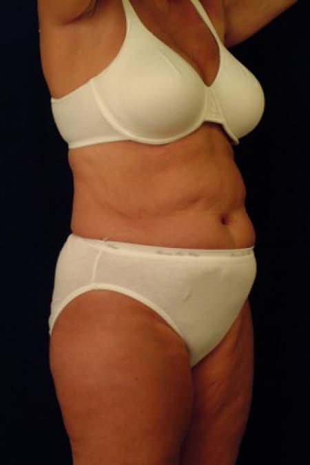 Before image 2 Case #87676 - Liposuction