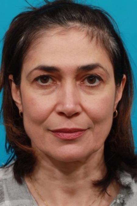 Before image 1 Case #85631 - Brow and Eyelid Lift