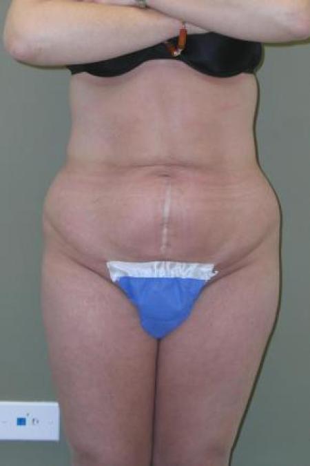 Before image 1 Case #80851 - Liposuction