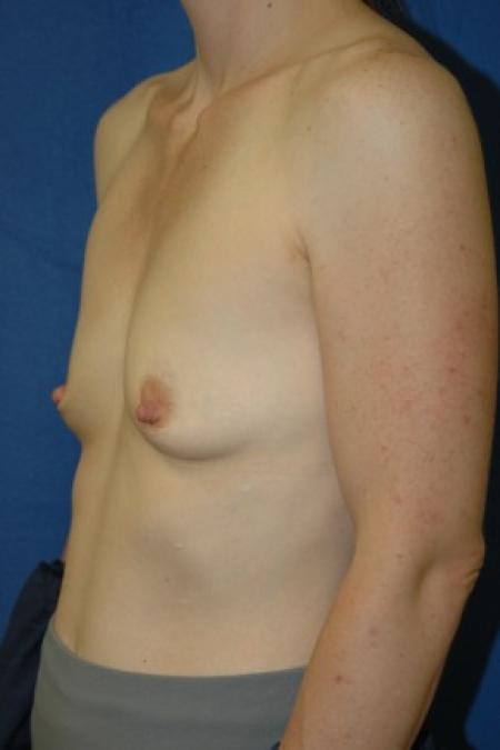 Before image 2 Case #81336 - Breast Augmentation using Allergan Style 410-MF335cc