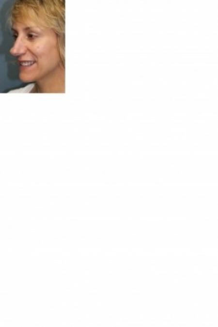 Before image 2 Case #81166 - Nose Reshaping