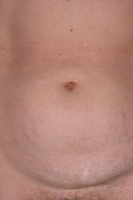 Before image 1 Case #81196 - Mini-abdominoplasty and Liposuction