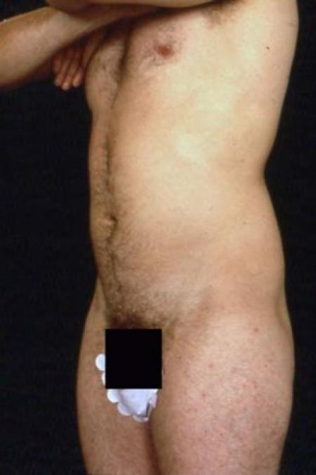 Before image 1 Case #81526 - Liposuction