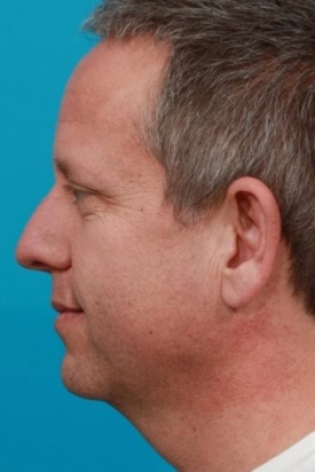 Before image 3 Case #78901 - Face / Neck Lift