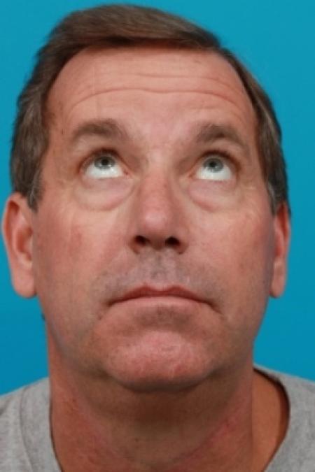 Before image 3 Case #78876 - Lower Blepharoplasty