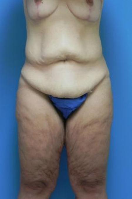 Before image 1 Case #80976 - Circumferential Body Lift and Breast Augmentation