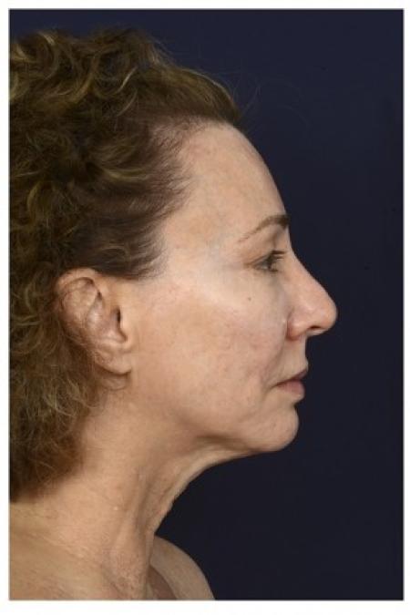 Before image 3 Case #86276 - 50 year old woman treated with Full Facial Rejuvenation