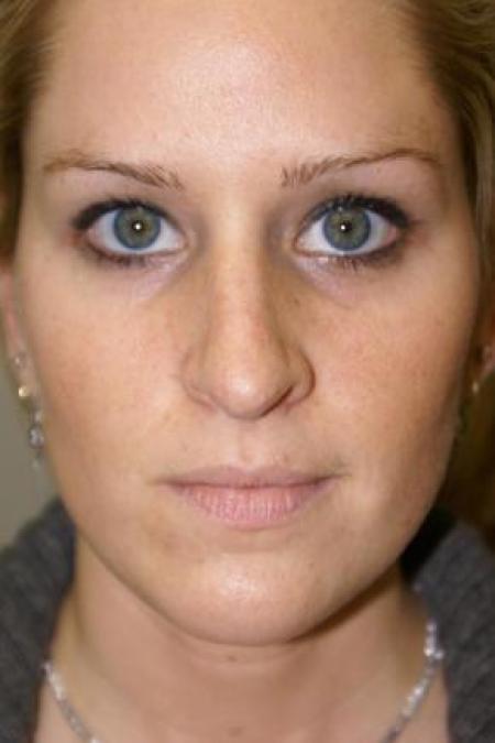 Before image 1 Case #80856 - Rhinoplasty