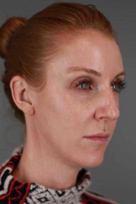 Before image 2 Case #87561 - Rhinoplasty