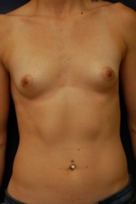 Before image 1 Case #81276 - Breast Augmentation