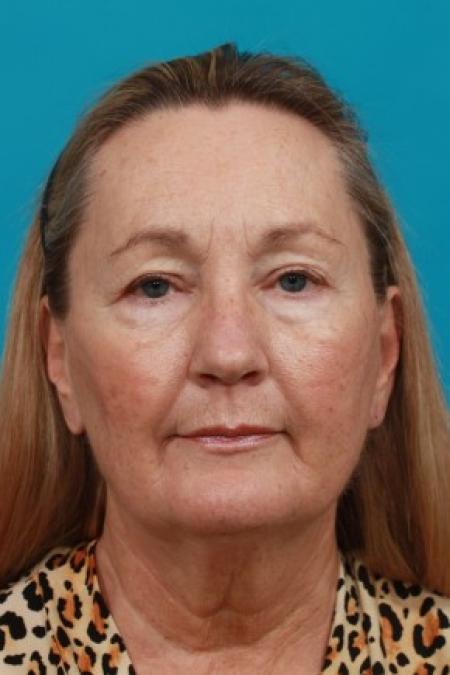 Before image 1 Case #86036 - Quad Blepharoplasty