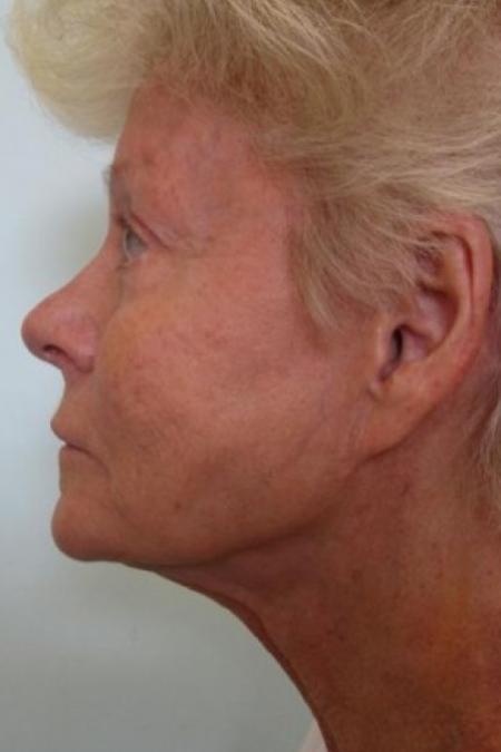 Before image 2 Case #82726 - Fat Transfer to lips and mouth