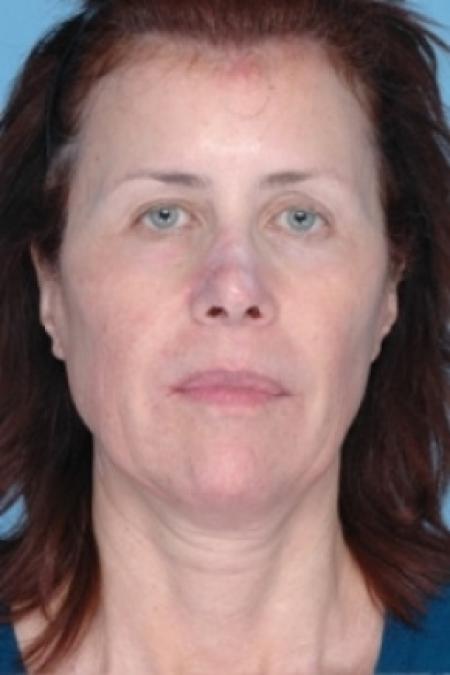 Before image 1 Case #79306 - Non-Surgical Focused Ultrasound