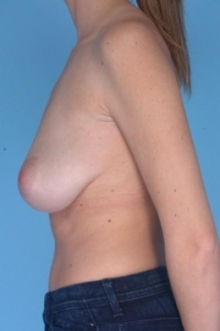 Before image 3 Case #80611 - Breast Reduction 