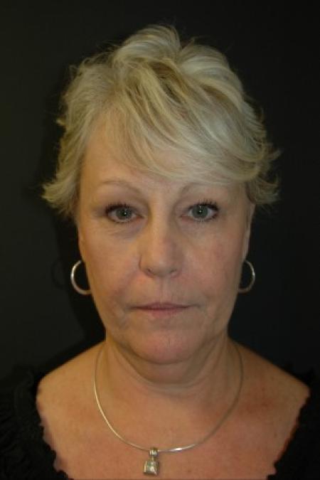 Before image 1 Case #81311 - Facelift, Fat Transfer, Lower Blepharoplasty