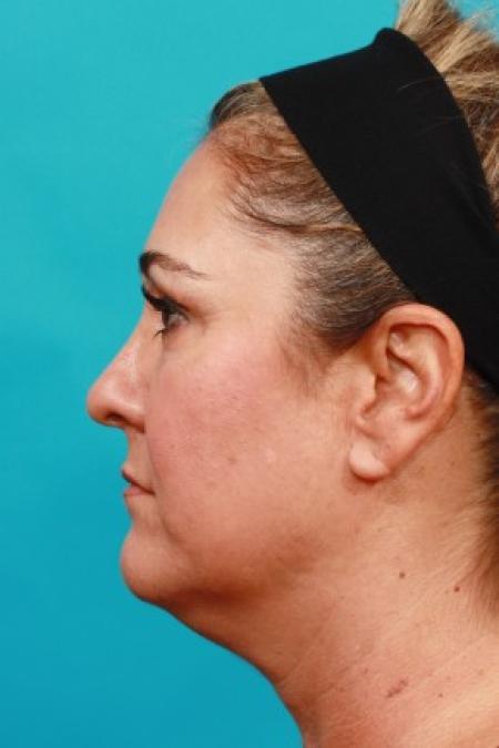 Before image 3 Case #86041 - Neck Lift AFTER Kybella