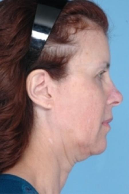 Before image 2 Case #79306 - Non-Surgical Focused Ultrasound