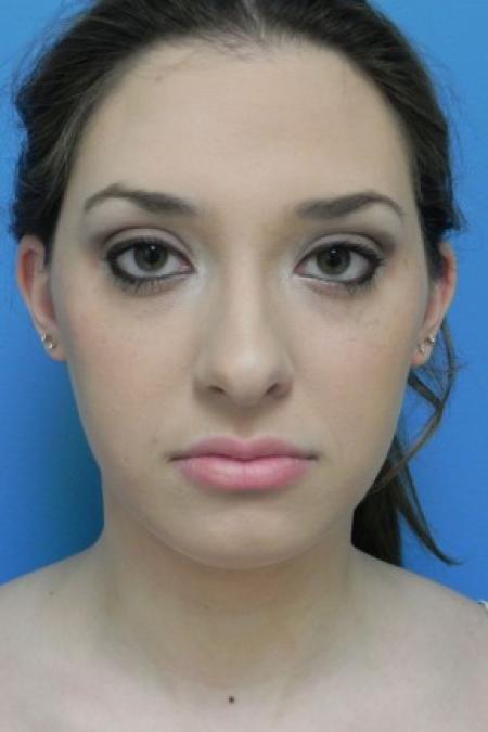 Before image 1 Case #81576 - Liposuction