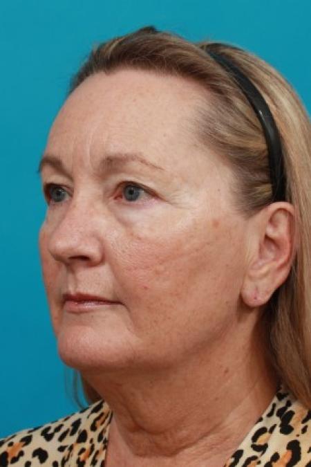 Before image 2 Case #86036 - Quad Blepharoplasty